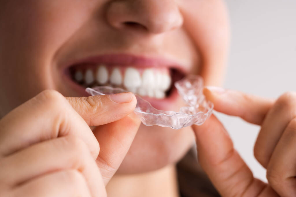 Invisalign Perth